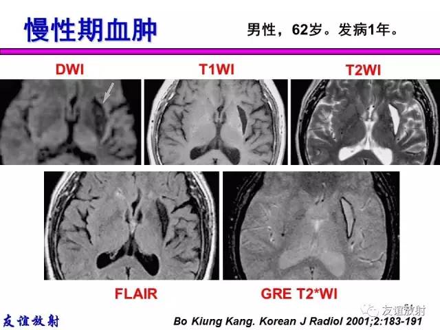 【PPT】基本病变的MR信号分析——出血MRI信号演变及分子机制