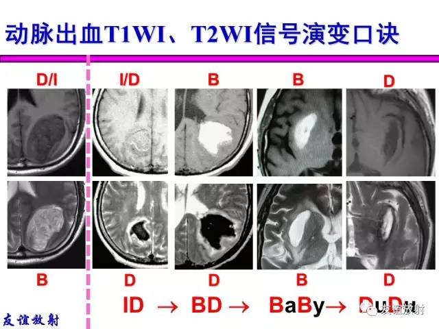 【PPT】基本病变的MR信号分析——出血MRI信号演变及分子机制