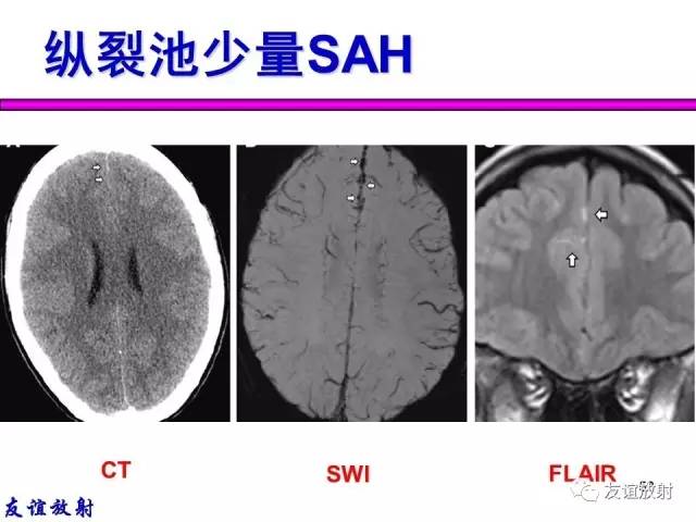 【PPT】基本病变的MR信号分析——出血MRI信号演变及分子机制