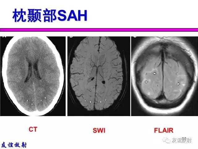 【PPT】基本病变的MR信号分析——出血MRI信号演变及分子机制