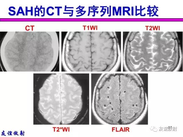 【PPT】基本病变的MR信号分析——出血MRI信号演变及分子机制