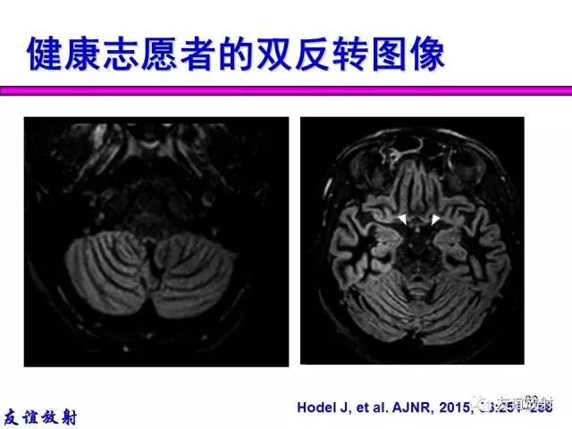 【PPT】基本病变的MR信号分析——出血MRI信号演变及分子机制