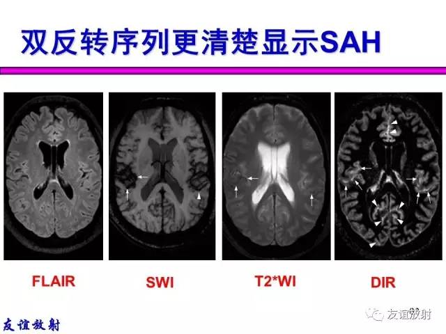 【PPT】基本病变的MR信号分析——出血MRI信号演变及分子机制