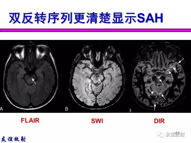 【PPT】基本病变的MR信号分析——出血MRI信号演变及分子机制