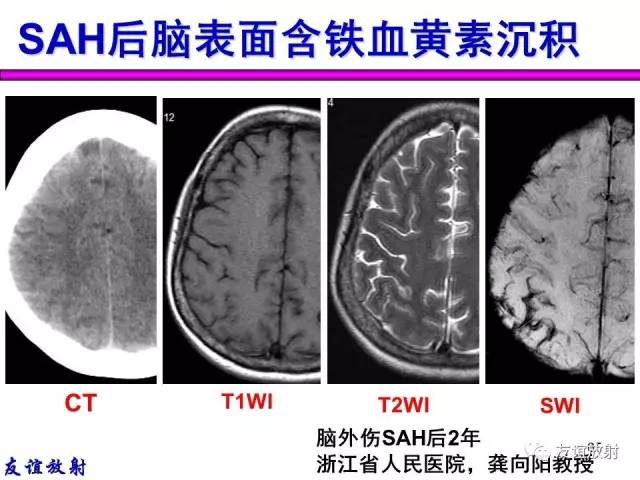 【PPT】基本病变的MR信号分析——出血MRI信号演变及分子机制