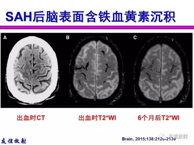 【PPT】基本病变的MR信号分析——出血MRI信号演变及分子机制