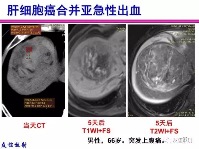 【PPT】基本病变的MR信号分析——出血MRI信号演变及分子机制