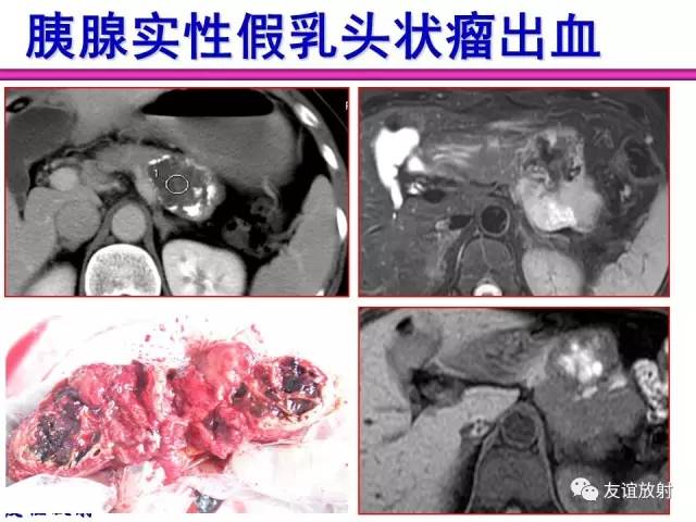 【PPT】基本病变的MR信号分析——出血MRI信号演变及分子机制