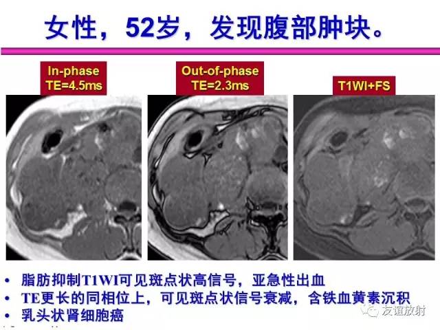 【PPT】基本病变的MR信号分析——出血MRI信号演变及分子机制