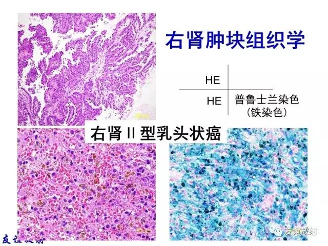 【PPT】基本病变的MR信号分析——出血MRI信号演变及分子机制
