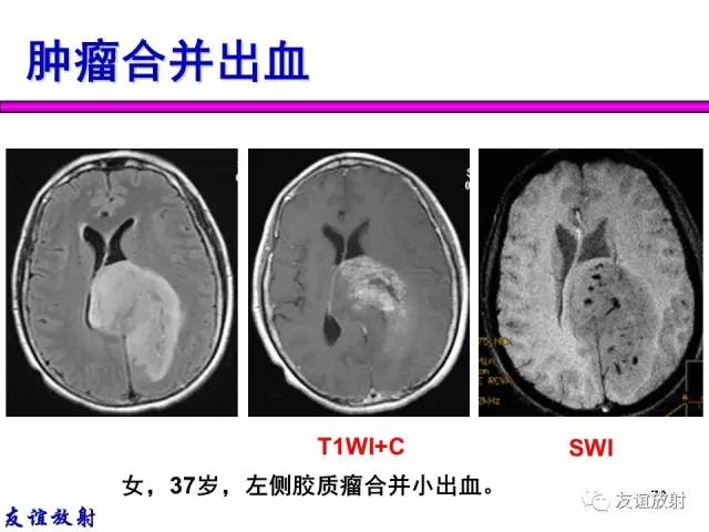 【PPT】基本病变的MR信号分析——出血MRI信号演变及分子机制