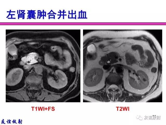 【PPT】基本病变的MR信号分析——出血MRI信号演变及分子机制