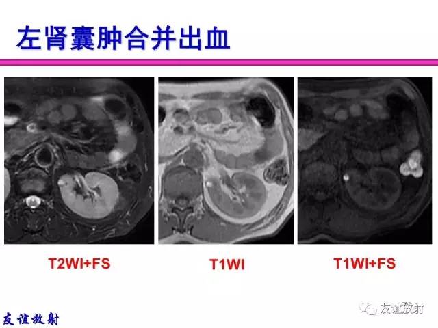【PPT】基本病变的MR信号分析——出血MRI信号演变及分子机制
