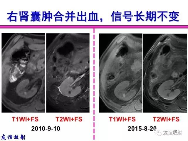 【PPT】基本病变的MR信号分析——出血MRI信号演变及分子机制