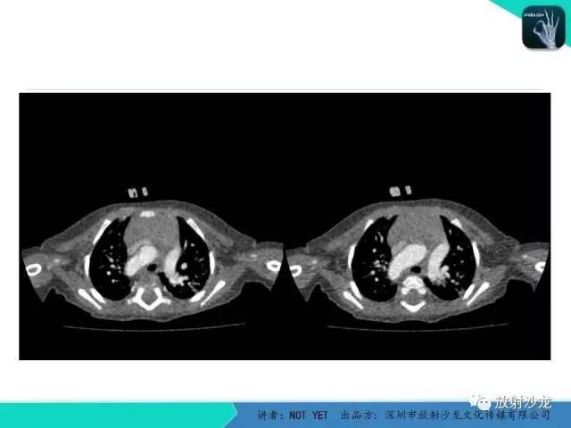 【病例】永存动脉干1例CT影像表现 【病例】永存动脉干1例CT影像表现
