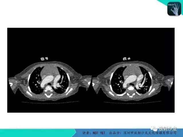 【病例】永存动脉干1例CT影像表现 【病例】永存动脉干1例CT影像表现