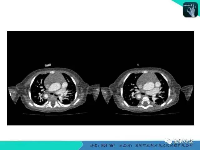 【病例】永存动脉干1例CT影像表现 【病例】永存动脉干1例CT影像表现