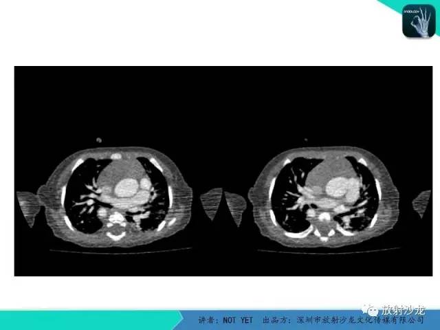 【病例】永存动脉干1例CT影像表现 【病例】永存动脉干1例CT影像表现