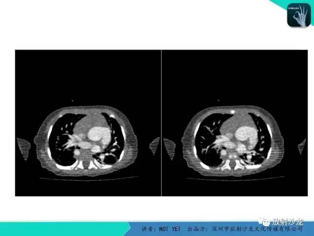 【病例】永存动脉干1例CT影像表现 【病例】永存动脉干1例CT影像表现