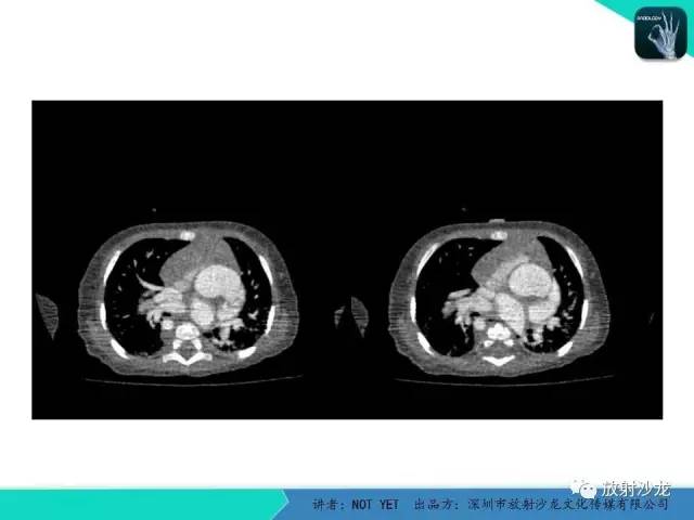 【病例】永存动脉干1例CT影像表现 【病例】永存动脉干1例CT影像表现