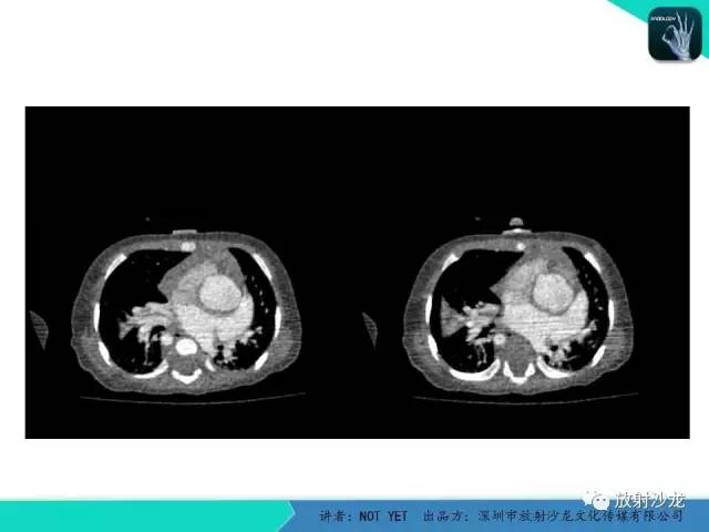 【病例】永存动脉干1例CT影像表现 【病例】永存动脉干1例CT影像表现