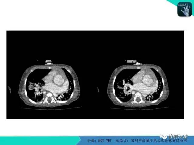 【病例】永存动脉干1例CT影像表现 【病例】永存动脉干1例CT影像表现