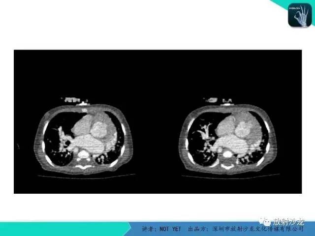 【病例】永存动脉干1例CT影像表现 【病例】永存动脉干1例CT影像表现