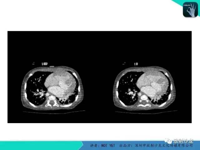 【病例】永存动脉干1例CT影像表现 【病例】永存动脉干1例CT影像表现