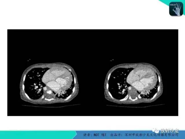 【病例】永存动脉干1例CT影像表现 【病例】永存动脉干1例CT影像表现