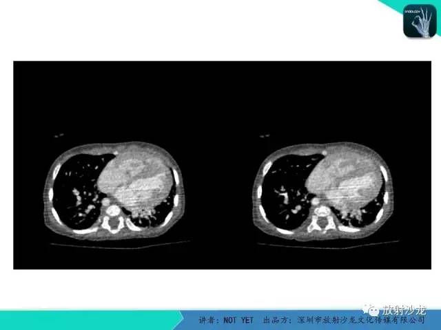 【病例】永存动脉干1例CT影像表现 【病例】永存动脉干1例CT影像表现