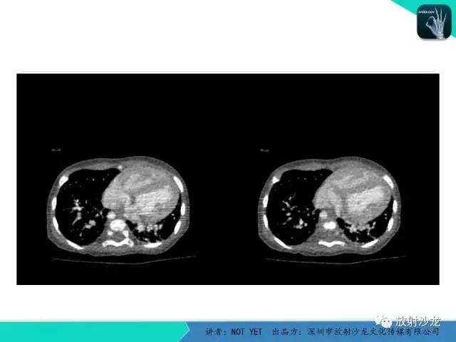 【病例】永存动脉干1例CT影像表现 【病例】永存动脉干1例CT影像表现