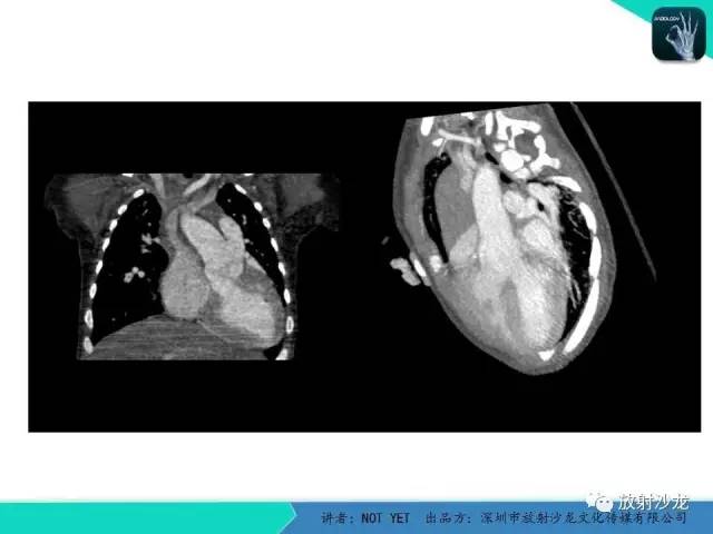 【病例】永存动脉干1例CT影像表现 【病例】永存动脉干1例CT影像表现