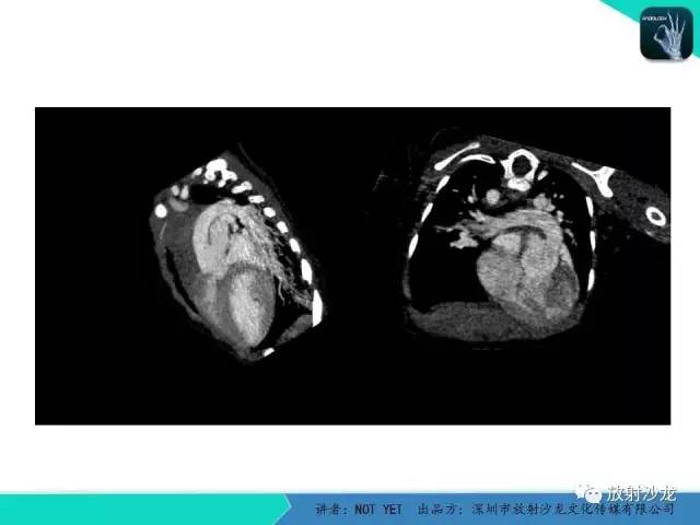 【病例】永存动脉干1例CT影像表现 【病例】永存动脉干1例CT影像表现