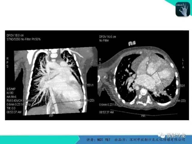 【病例】永存动脉干1例CT影像表现 【病例】永存动脉干1例CT影像表现