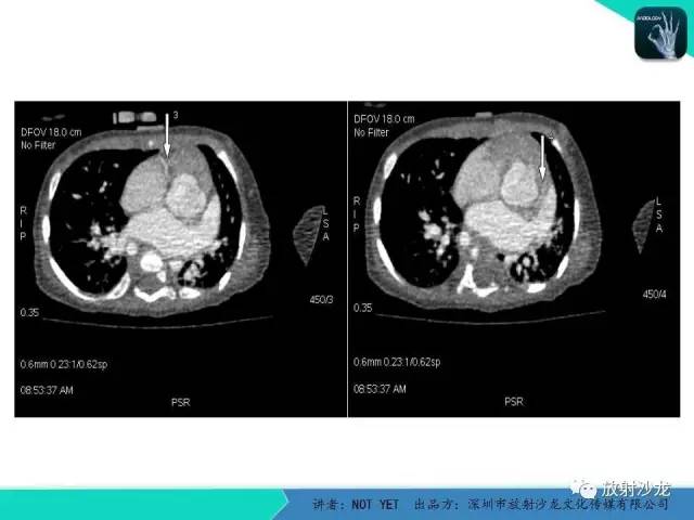 【病例】永存动脉干1例CT影像表现 【病例】永存动脉干1例CT影像表现