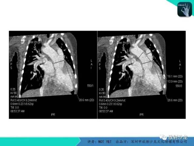 【病例】永存动脉干1例CT影像表现 【病例】永存动脉干1例CT影像表现