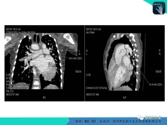 【病例】永存动脉干1例CT影像表现 【病例】永存动脉干1例CT影像表现