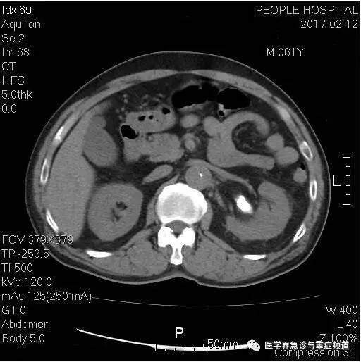 【病例】差点漏诊的主动脉夹层1例CT