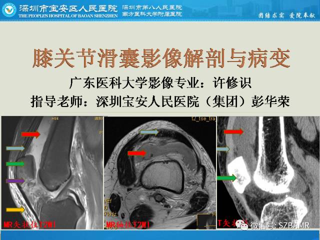 【PPT】膝关节滑囊影像解剖与病变