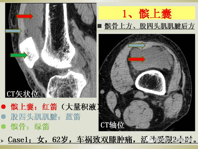 【PPT】膝关节滑囊影像解剖与病变