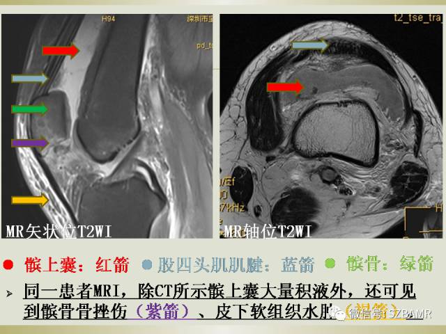 【PPT】膝关节滑囊影像解剖与病变