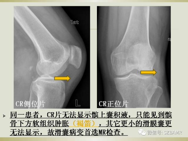 【PPT】膝关节滑囊影像解剖与病变
