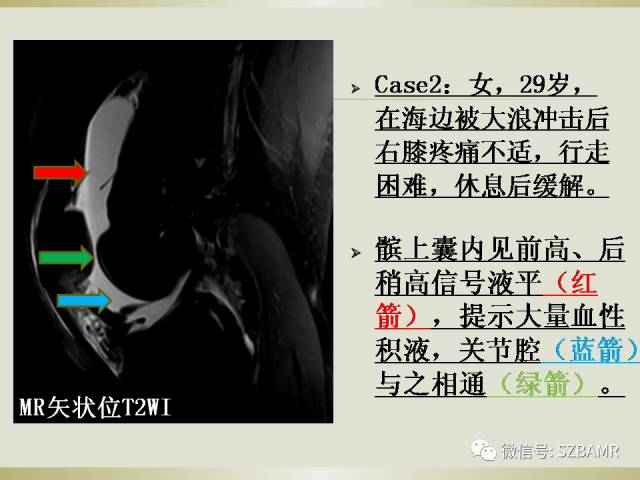 【PPT】膝关节滑囊影像解剖与病变