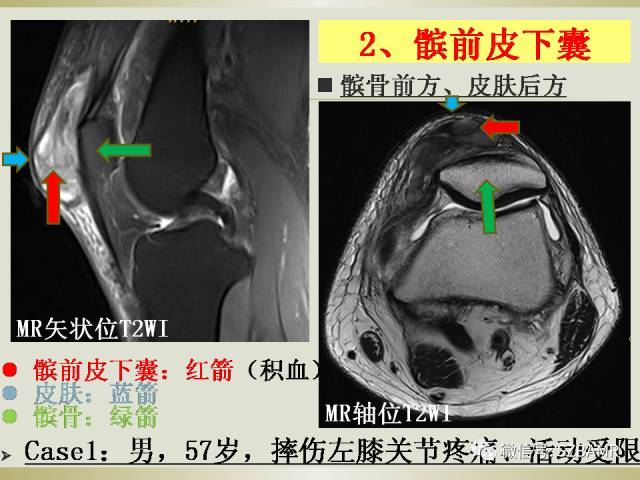 【PPT】膝关节滑囊影像解剖与病变