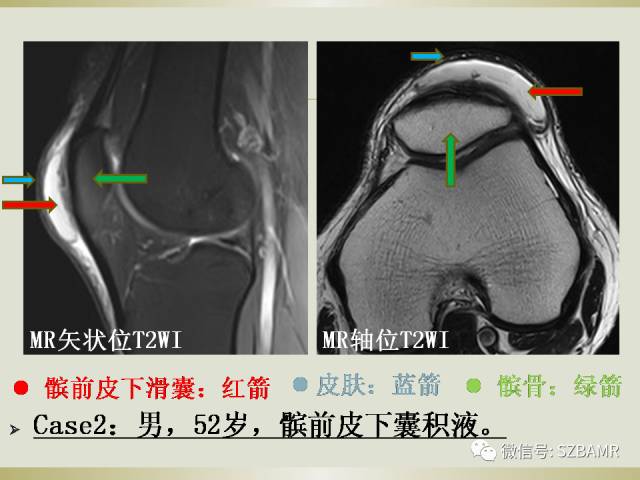 【PPT】膝关节滑囊影像解剖与病变