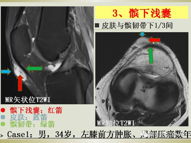 【PPT】膝关节滑囊影像解剖与病变
