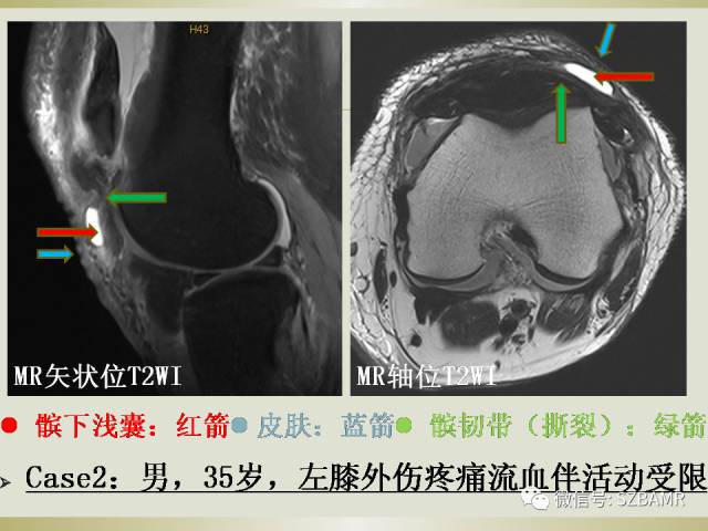 【PPT】膝关节滑囊影像解剖与病变