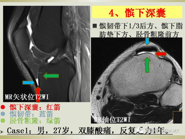 【PPT】膝关节滑囊影像解剖与病变