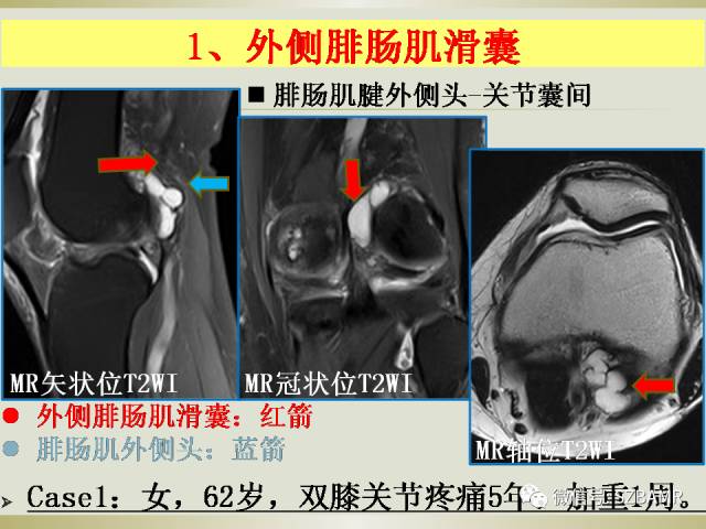 【PPT】膝关节滑囊影像解剖与病变