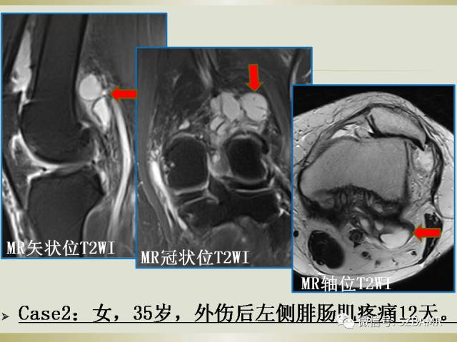 【PPT】膝关节滑囊影像解剖与病变
